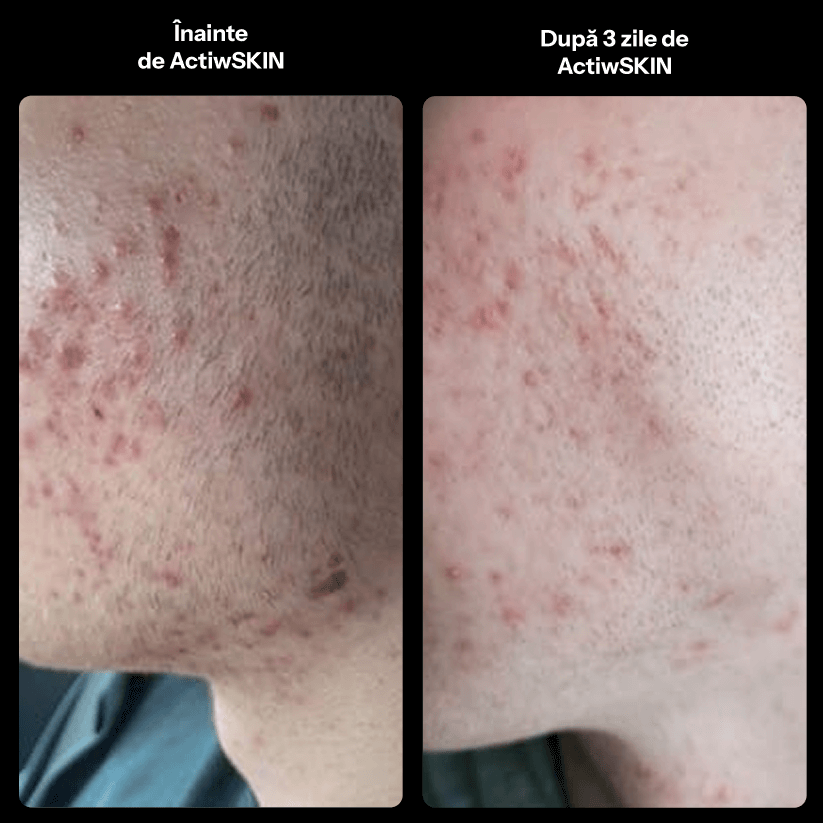 ActiW SKIN -PENTRU ACNEE - Pachet Complet - Tratament 42-50 de zile