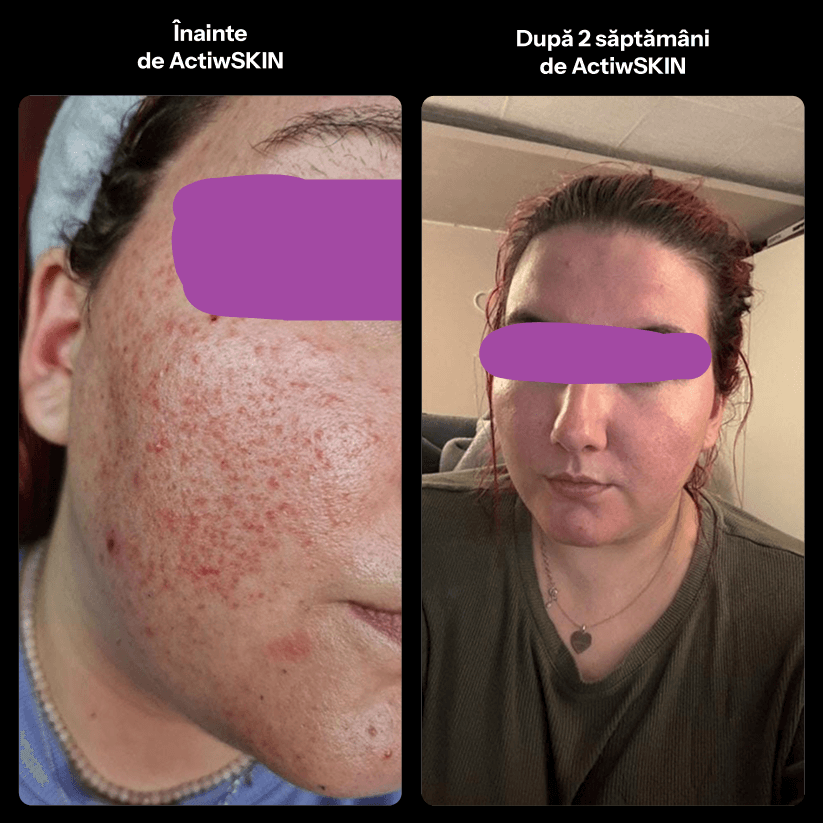 ActiW SKIN -PENTRU ACNEE - Pachet Complet - Tratament 42-50 de zile