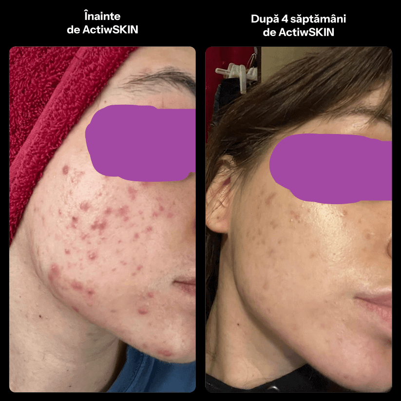 ActiW SKIN -PENTRU ACNEE - Pachet Complet - Tratament 42-50 de zile
