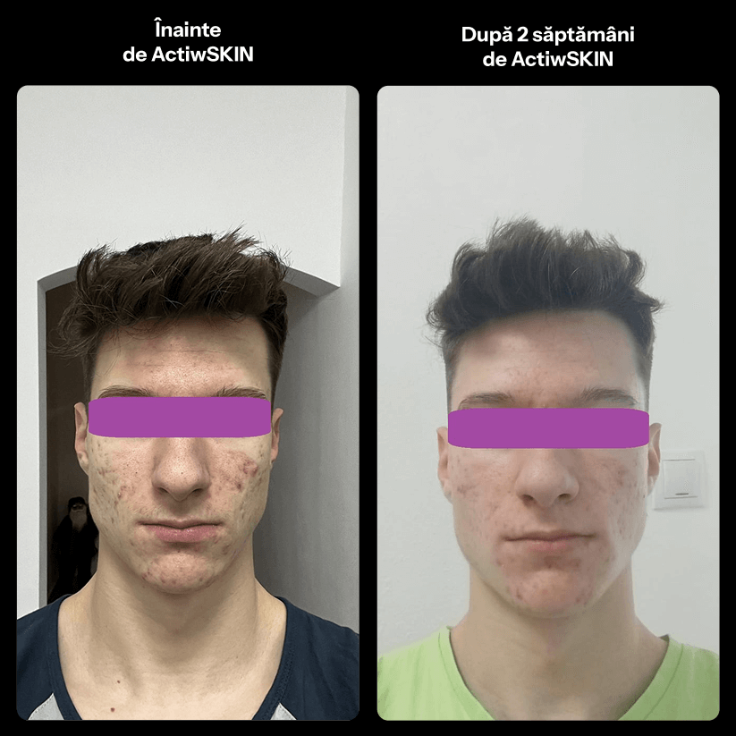 ActiW SKIN -PENTRU ACNEE - Pachet Complet - Tratament 42-50 de zile