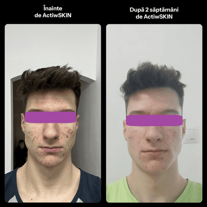 ActiW SKIN -PENTRU ACNEE - Pachet Complet - Tratament 42-50 de zile